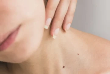 Vrouwelijke nek met moedervlek en hand.