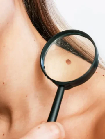 moedervlek controleren met vergrootglas